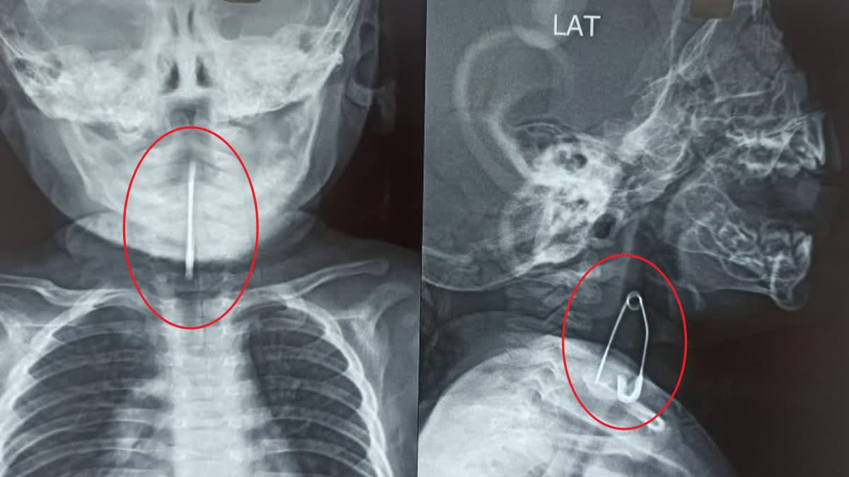 Doctors in Kolkata remove safety pin stuck in 5 month old babys trachea