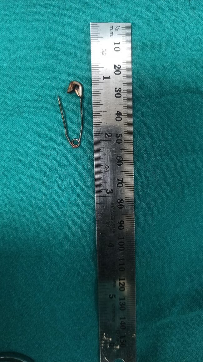 Safety Pin Stuck Boy Trachea