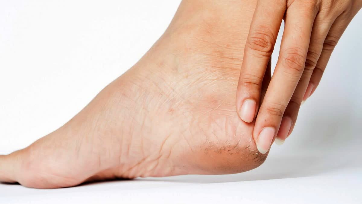 Deficiency Causes Cracked Feet