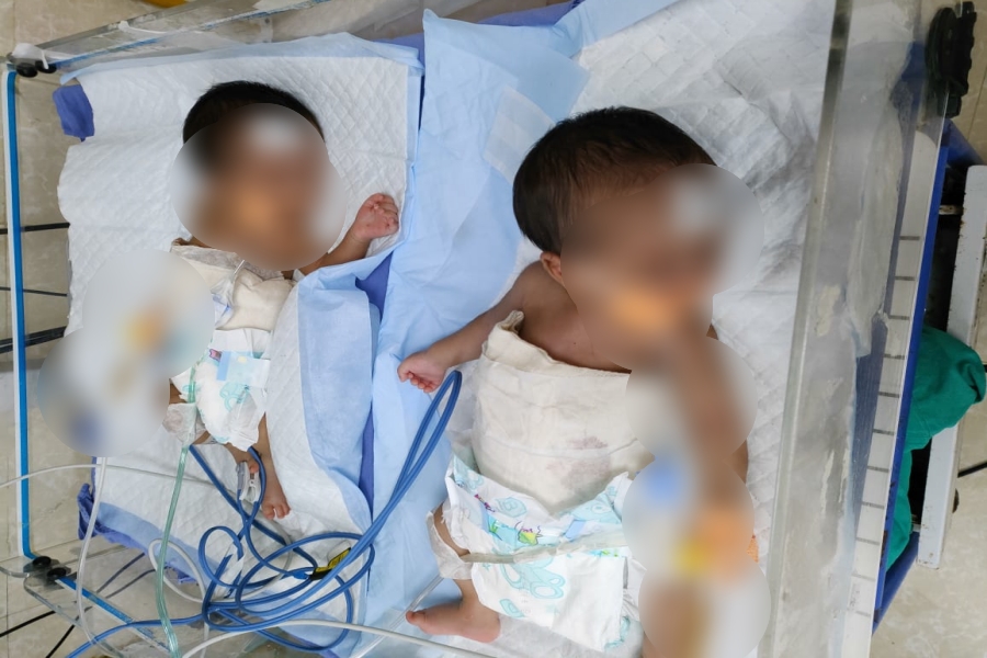 Conjoined Twins Operated in NRS