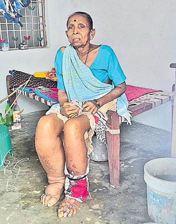 Filariasis patients problems in pedapenki at parvathipuram manyam district