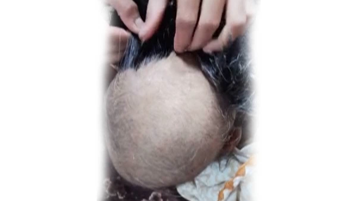 Side effect of baldness virus Obstacles