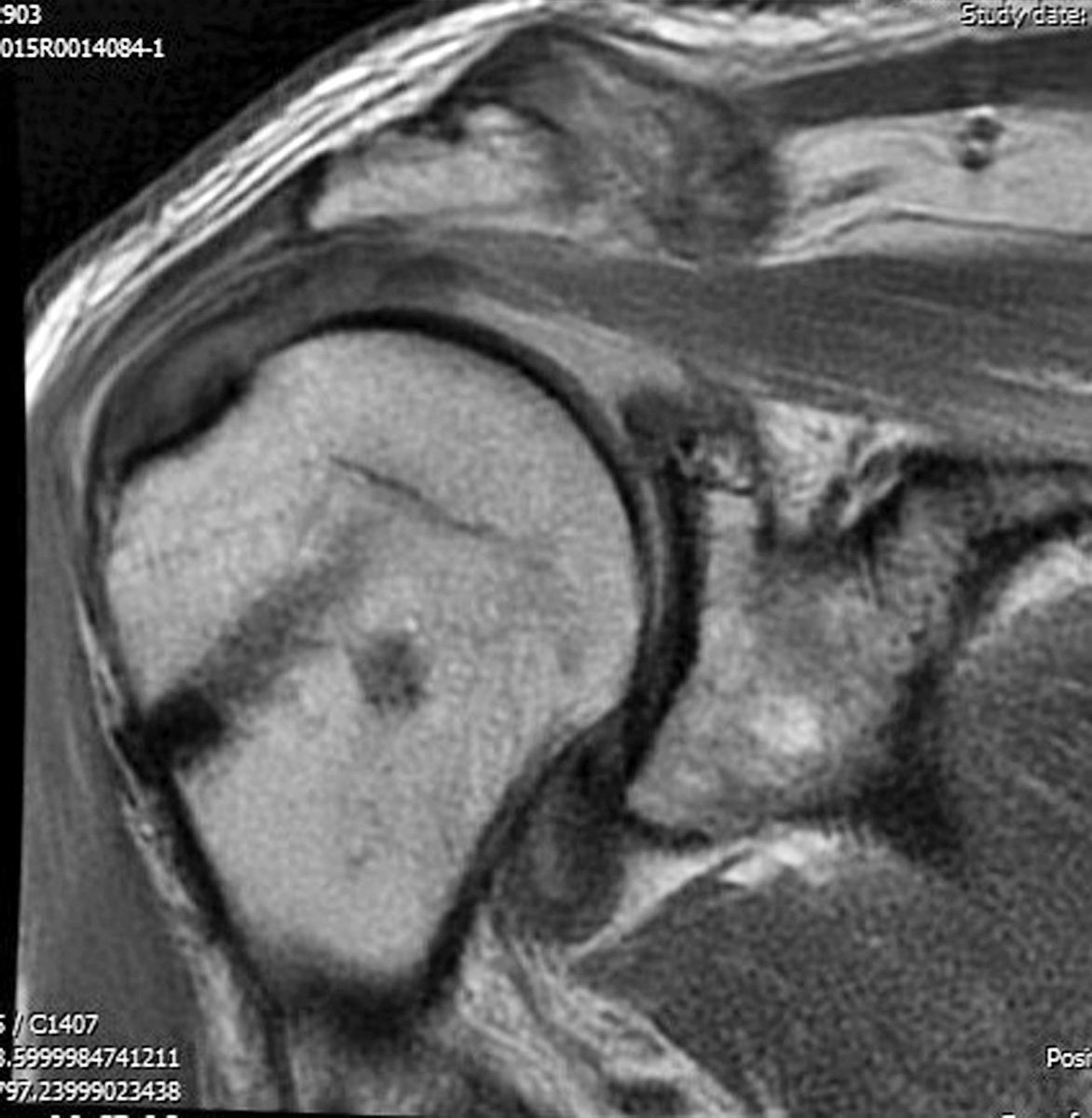 ATOK anchor in place with healed rotator cuff tear at 12 months postoperatively.