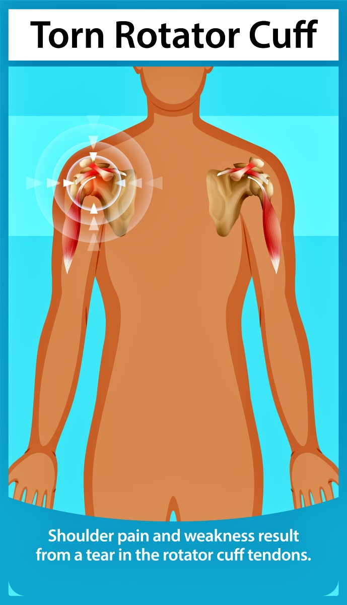 Illustration of a torn rotator cuff