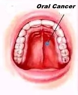know the reason behind oral cancer cases in Indian youths