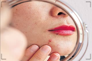 How To reduce acne pain