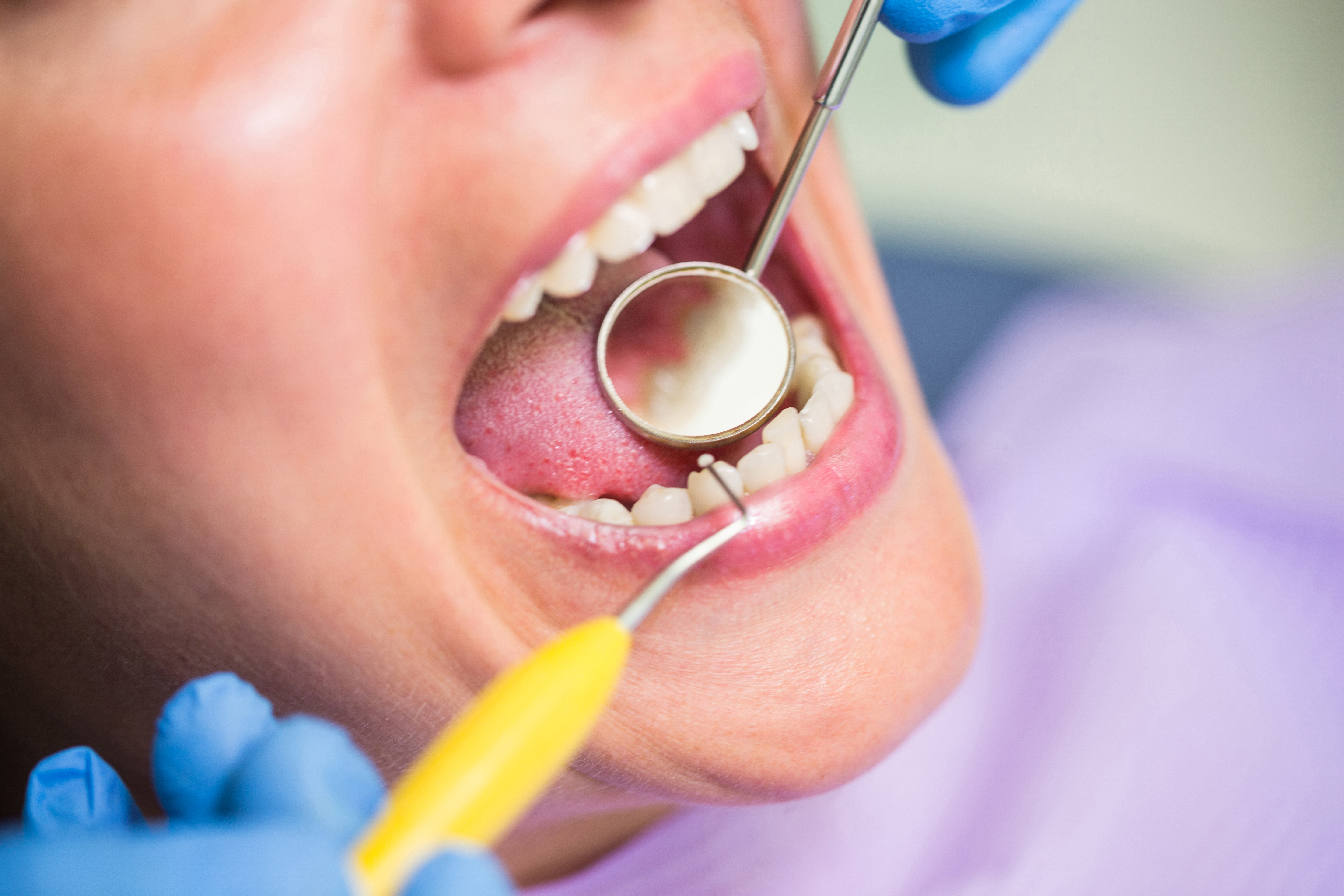 Do not ignore tartar in your teeth, it can cause many problems