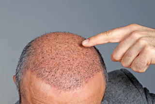 HAIR TRANSPLANT SIDE EFFECTS