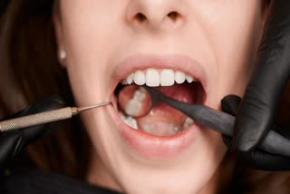 Do not ignore tartar in your teeth, it can cause many problems