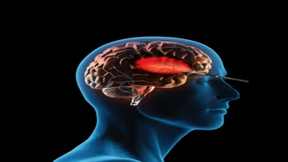 Balrampur Hospital in Lucknow has become the first district hospital to offer surgical treatment for Trigeminal Neuralgia, also known as the suicide disease (mainly because of the high-level pain that the patient suffers).