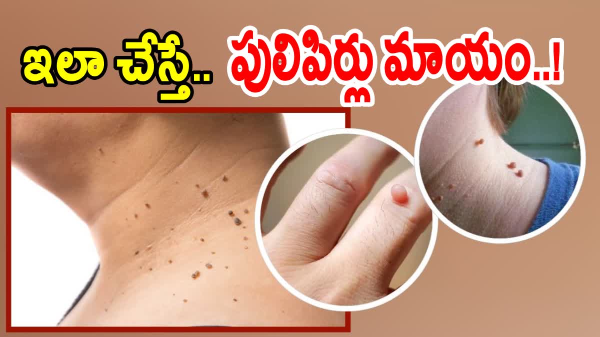 Natural Tips to Remove Warts