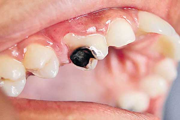 Teeth Problems In Pregnants