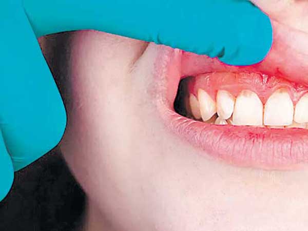 Teeth Problems In Pregnants