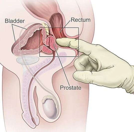 prostate cancer