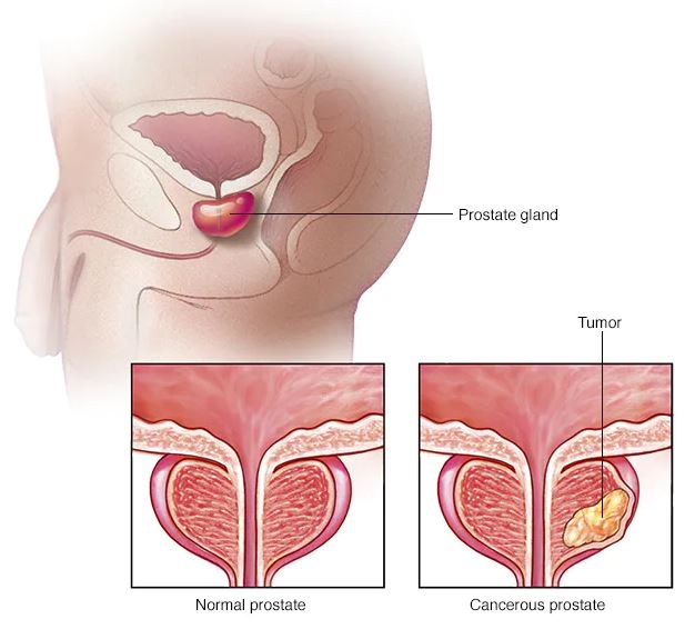 Prostate cancer