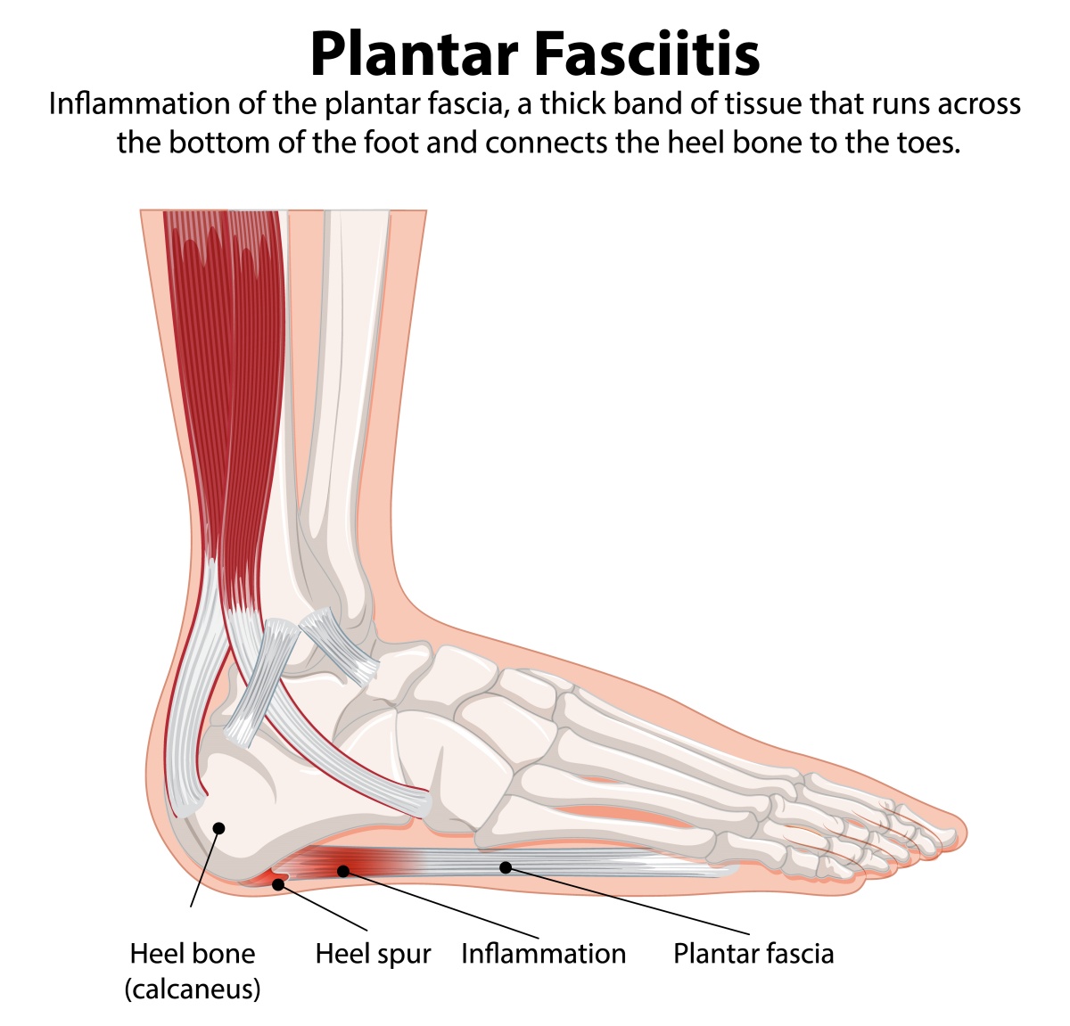 Illustration of heel pain