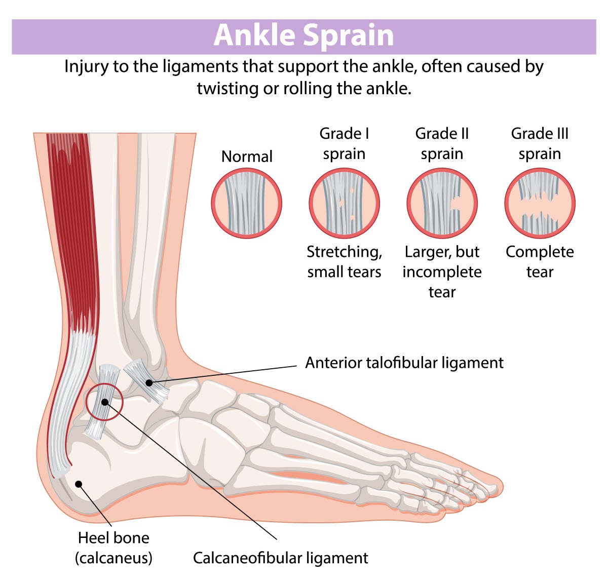 Illustration of ankle sprain