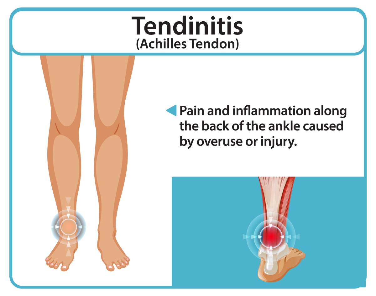 Illustration of Achilles Tendon