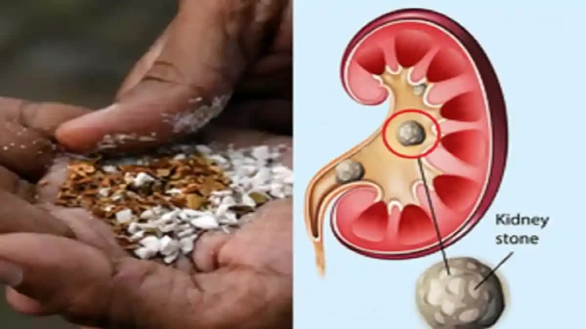 Pan masala can cause kidney stones