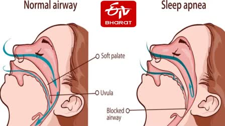 स्लीप एपनिया से बचाव की तकनीकि विकसित.