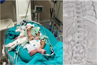 Cardiac Surgery of 9 Day Old Newborn