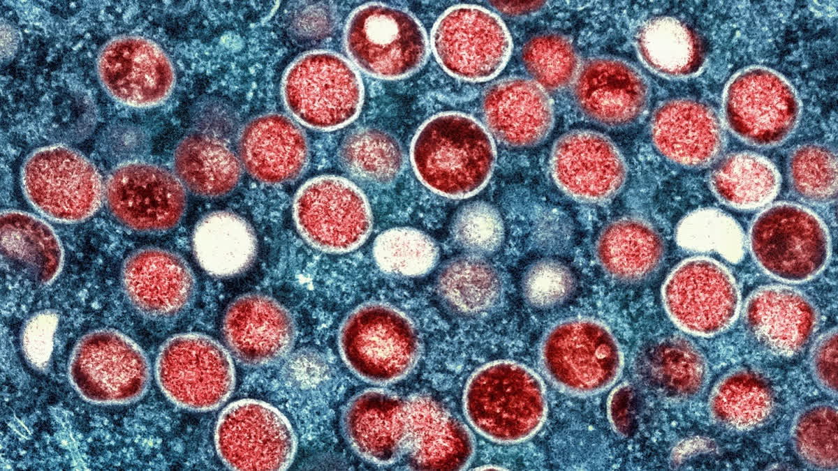 This undated image provided by the National Institute of Allergy and Infectious Diseases shows a colorized transmission electron micrograph of monkeypox particles (red) found within an infected cell (blue), cultured in the laboratory that was captured and color-enhanced at the NIAID Integrated Research Facility in Fort Detrick, Md.