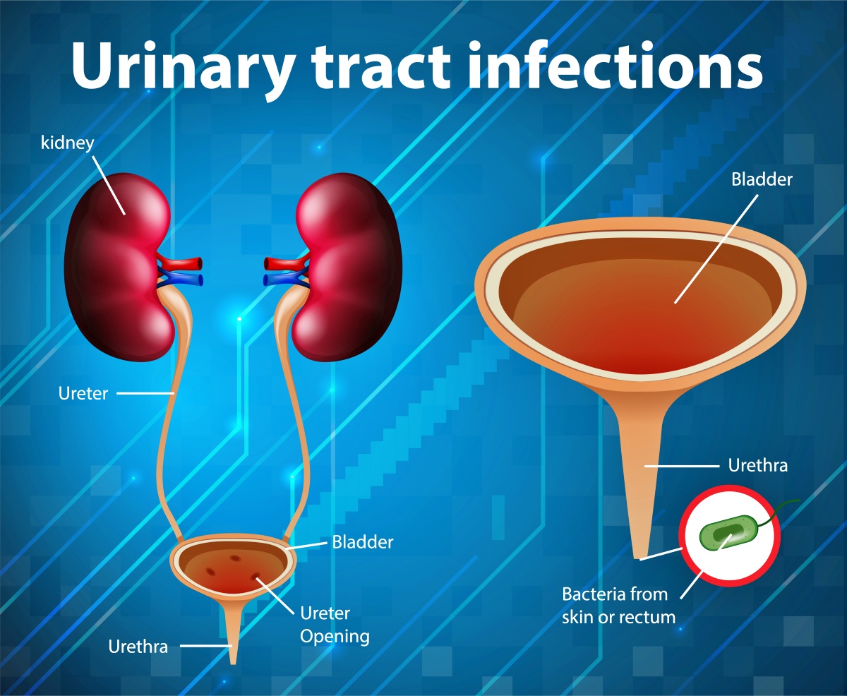 Visual representation of a UTI