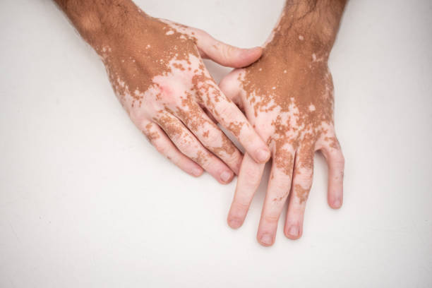 Vitiligo is a skin disorder