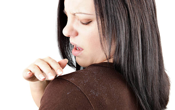 Dandruff Control Tips