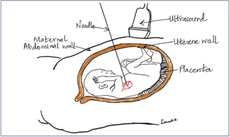 The Magical Procedure: In-utero aortic valve modification to reshape the heart development