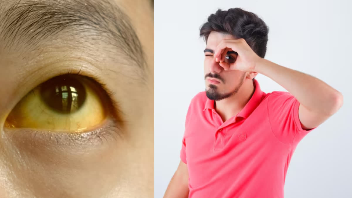 Do your eyes look yellow? Are you at risk of these 7 diseases? Know the opinion of experts