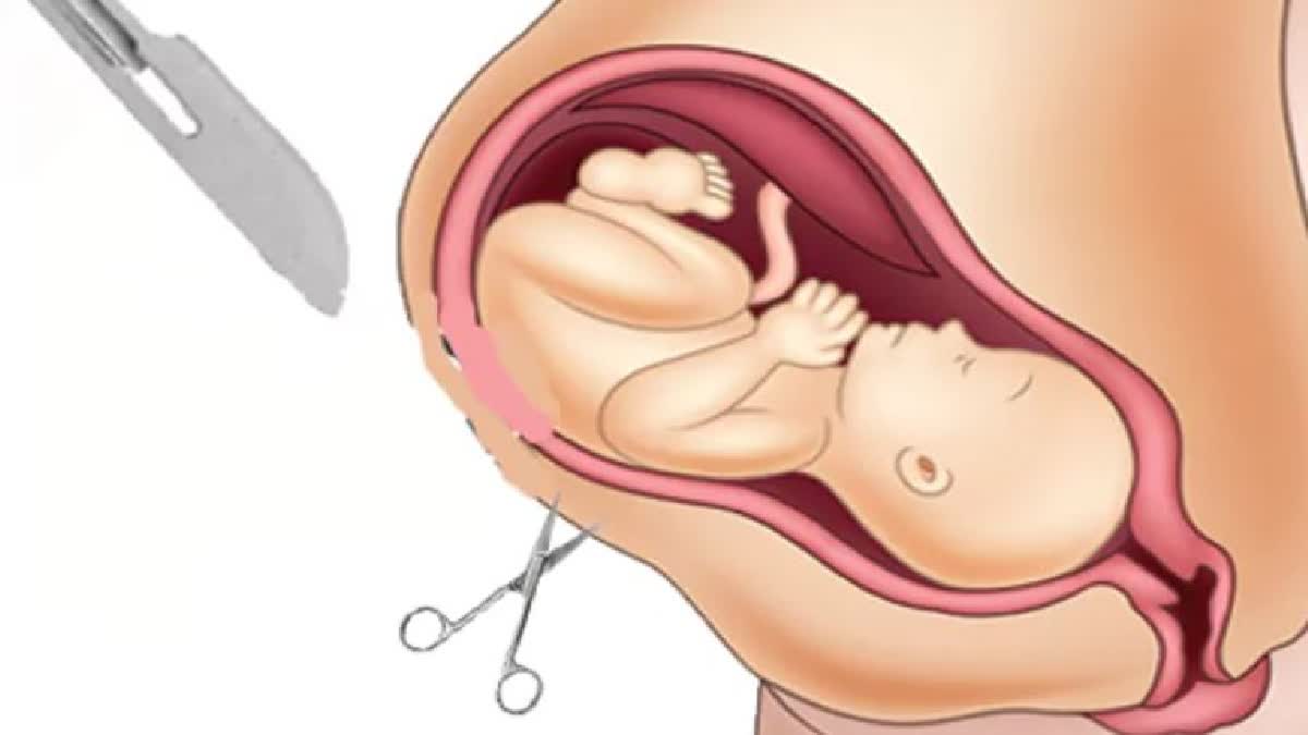 CESAREAN DELIVERIES