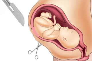 CESAREAN DELIVERIES