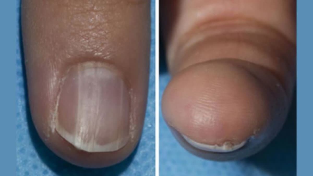 Cancer Symptoms In Nails