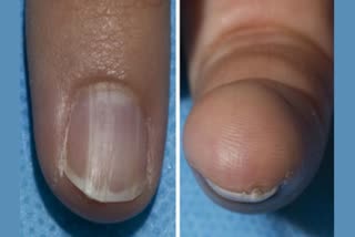 Cancer Symptoms In Nails