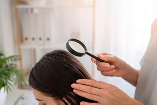 HOME REMEDIES FOR DANDRUFF  NATURAL WAYS TO GET RID OF DANDRUFF  TIPS TO TREAT DANDRUFF  WAYS TO REMOVE DANDRUFF QUICKLY
