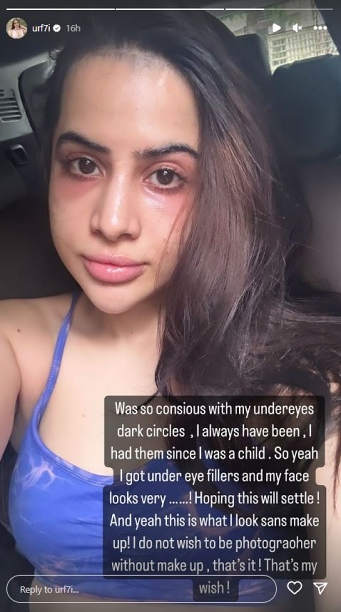 'Got undereye fillers and my face looks very...': Uorfi Javed's cosmetic treatment goes horribly wrong, shares no filter pictures regretting her decision