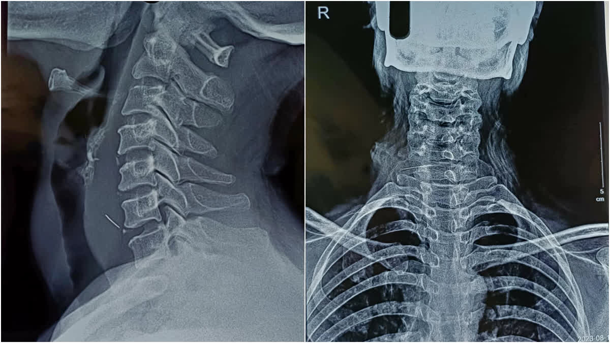 North Bengal Medical College doctors  iron wire stuck in womans throat  doctors removed iron wire stuck in womans throat  rare surgery  തൊണ്ടയിൽ ഇരുമ്പ് കമ്പി കുടുങ്ങി  അപൂർവ ശസ്‌ത്രക്രിയ  മൂന്ന് സെന്‍റിമീറ്റർ നീളമുള്ള ഇരുമ്പ് കമ്പി  നോർത്ത് ബംഗാൾ മെഡിക്കൽ കോളജ്