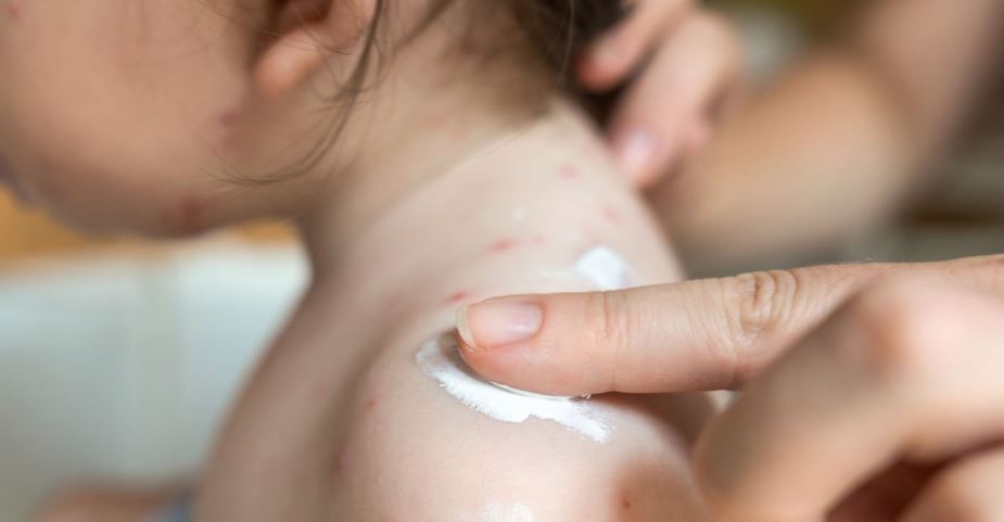 Rashes On Babies Skin