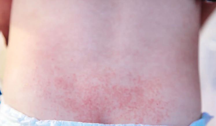 Rashes On Babies Skin