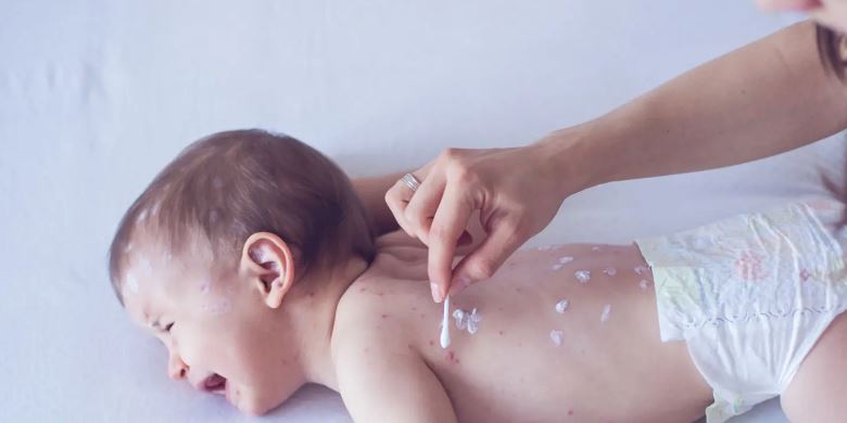 Rashes On Babies Skin