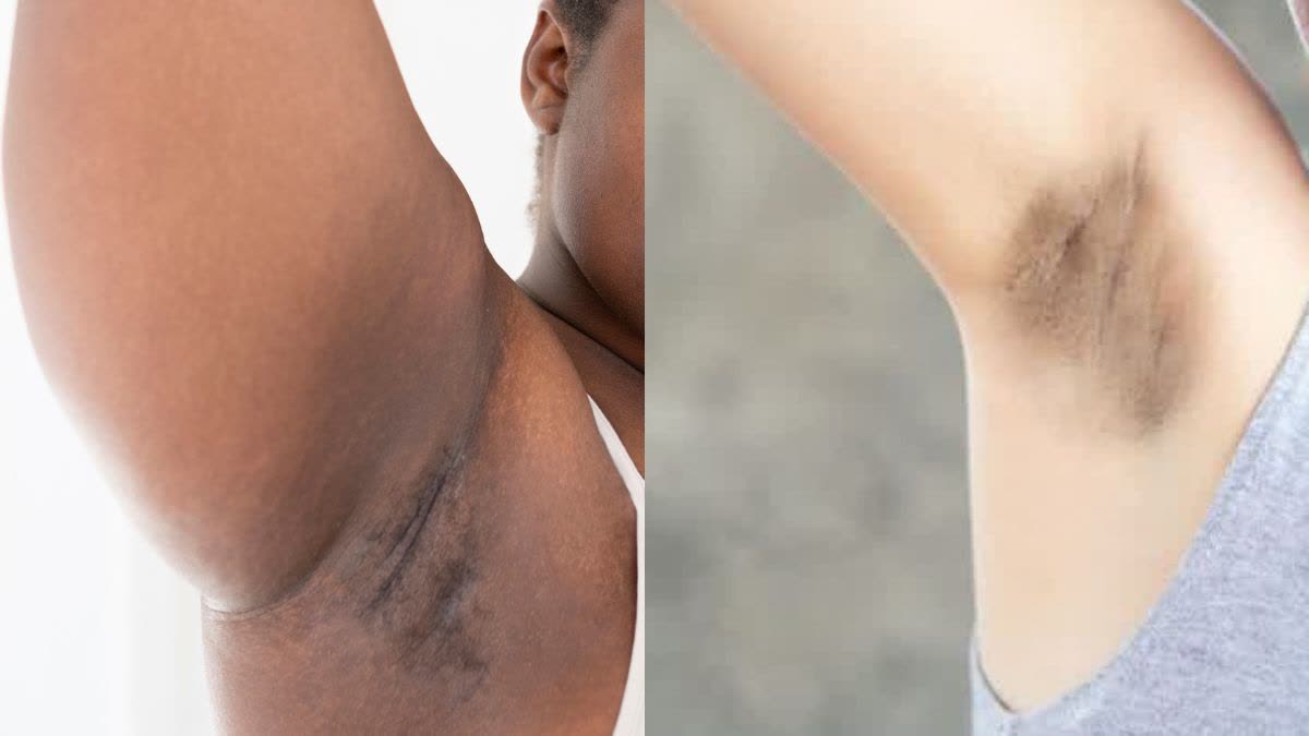 Tips for Dark Underarms