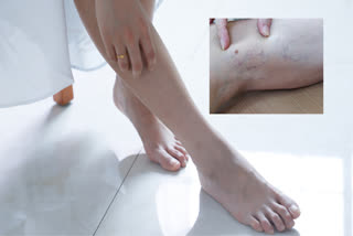 Your feet indicate many diseases growing silently in the body,