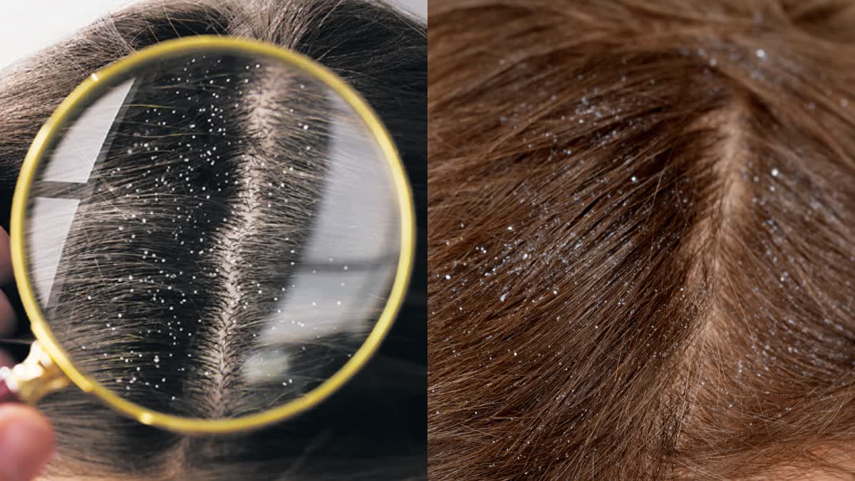 Dandruff Treatment at Home