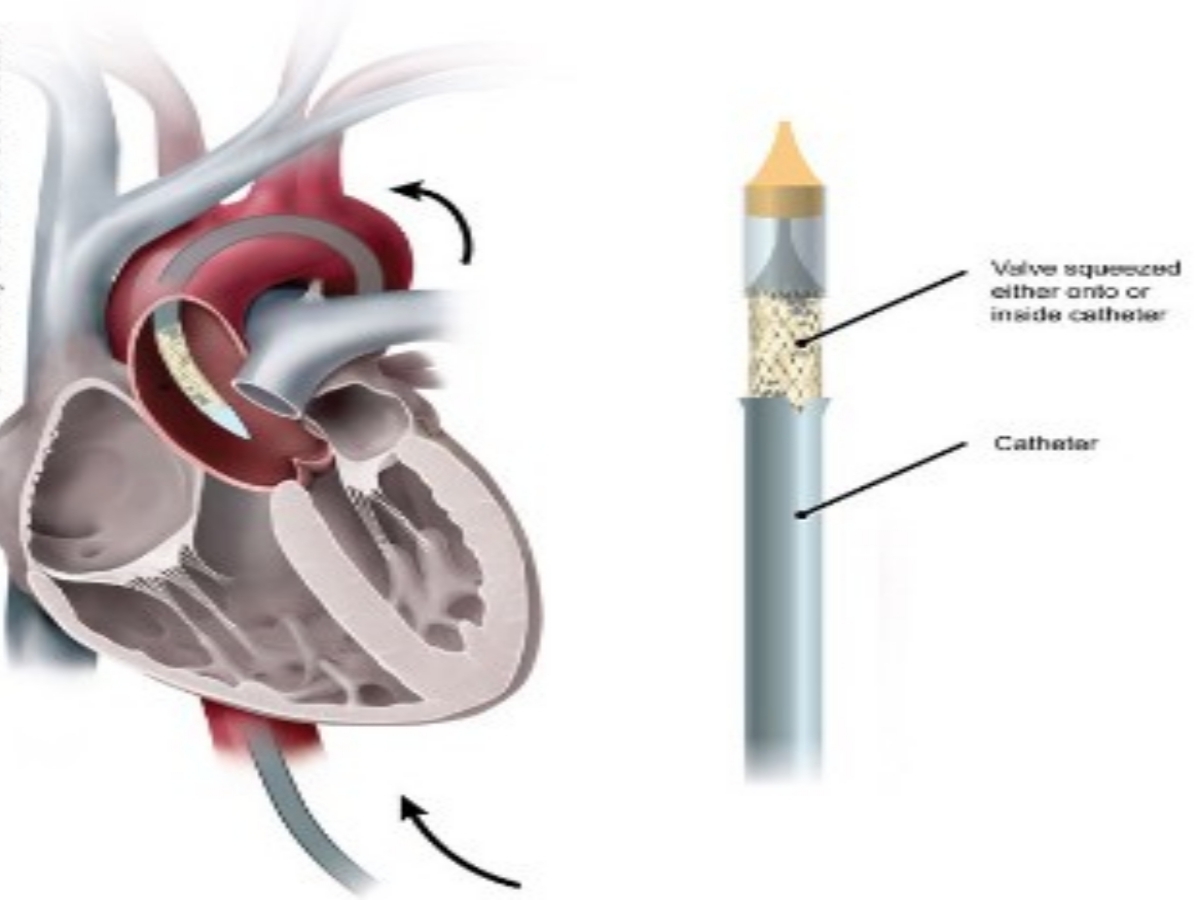 tavi method in chandigarh