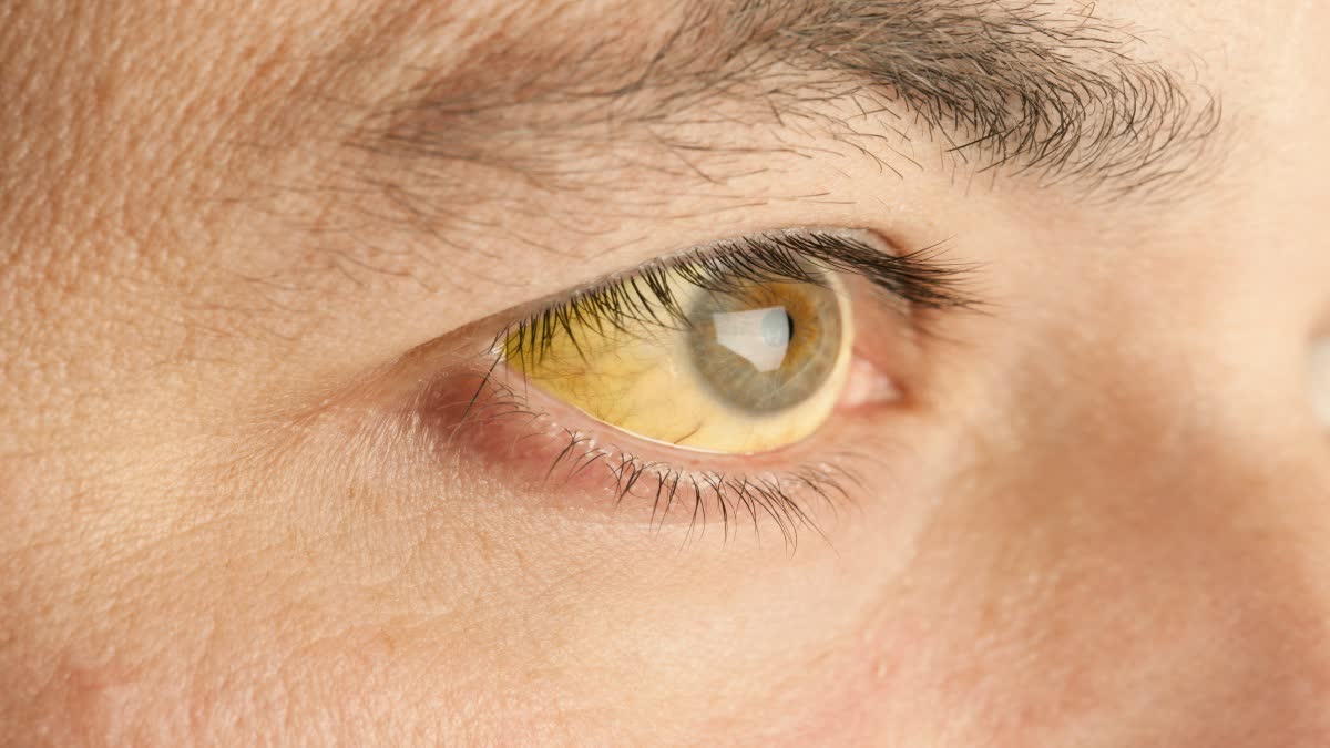 DO YOUR EYES LOOK YELLOW  Yellow Eyes Causes And Treatments  Remove Yellowness From Eyes