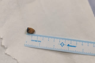 Pen cap removed from the lungs of a patient in Hyderabad.