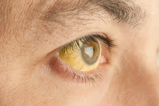 The most common and noticeable first sign of liver problems is jaundice, where the whites of your eyes turn yellow (Representational Image)