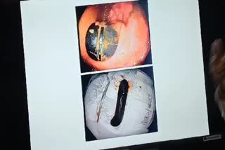 44 साल के एक व्यक्ति के रेक्टम में फंसा वाइब्रेटर