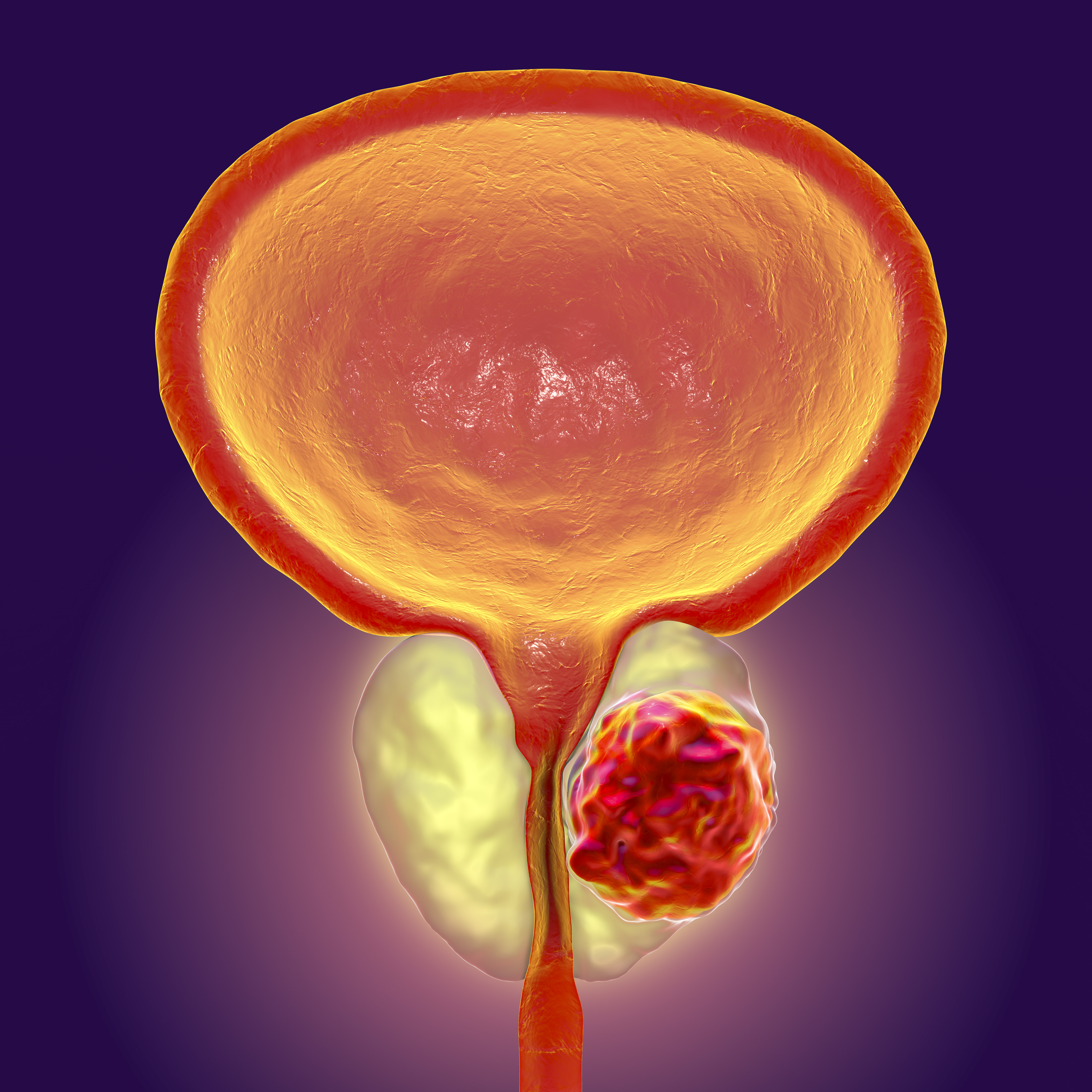 JOE BIDEN Former President Joe Biden prostate cancer Symptoms prostate cancer Treatment